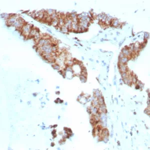 Formalin-fixed, paraffin-embedded human colon carcinoma stained with CD269 Recombinant Mouse Monoclonal Antibody (rCD269/8507). HIER: Tris/EDTA, pH9.0, 45min. 2°C: HRP-polymer, 30min. DAB, 5min.