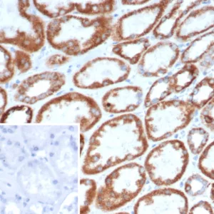 Formalin-fixed, paraffin-embedded human gastric carcinoma stained with CD269 / TNFRSF17 Mouse Monoclonal Antibody (BCMA/7253). Inset: PBS instead of primary antibody; secondary only negative control.