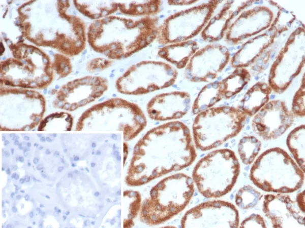 Formalin-fixed, paraffin-embedded human gastric carcinoma stained with CD269 / TNFRSF17 Mouse Monoclonal Antibody (BCMA/7253). Inset: PBS instead of primary antibody; secondary only negative control.