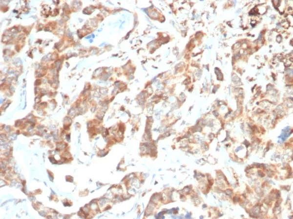 Formalin-fixed, paraffin-embedded human colon carcinoma stained with CD269 / TNFRSF17 Mouse Monoclonal Antibody (BCMA/7254). HIER: Tris/EDTA, pH9.0, 45min. 2°C: HRP-polymer, 30min. DAB, 5min.