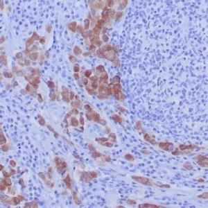 Formalin-fixed, paraffin-embedded human lung carcinoma stained with  ROS1 Recombinant Rabbit Monoclonal Antibody (ROS1/7999R). HIER: Tris/EDTA, pH9.0, 45min. 2°C: HRP-polymer, 30min. DAB, 5min.