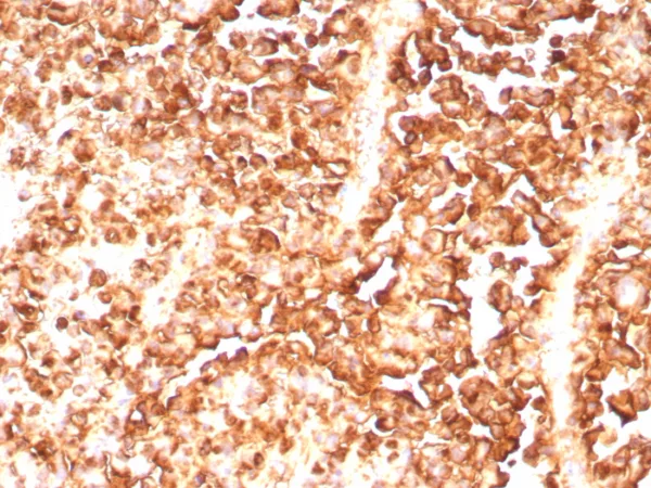 Formalin-fixed, paraffin-embedded human melanoma stained with S100A1 Rabbit Monoclonal Antibody (S100A1/9244R). HIER: Tris/EDTA, pH9.0, 45min. 2°C: HRP-polymer, 30min. DAB, 5min.