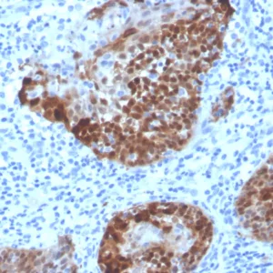 Formalin-fixed, paraffin-embedded human cervix stained with S100A2 Mouse Monoclonal Antibody (S100A2/6925). HIER: Tris/EDTA, pH9.0, 45min. 2°C: HRP-polymer, 30min. DAB, 5min.