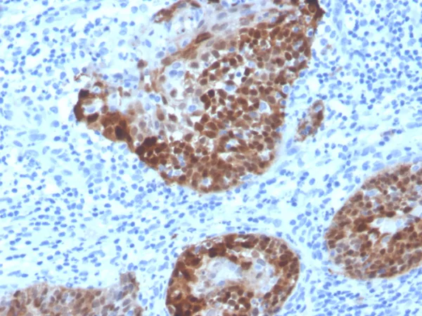 Formalin-fixed, paraffin-embedded human cervix stained with S100A2 Mouse Monoclonal Antibody (S100A2/6925). HIER: Tris/EDTA, pH9.0, 45min. 2°C: HRP-polymer, 30min. DAB, 5min.
