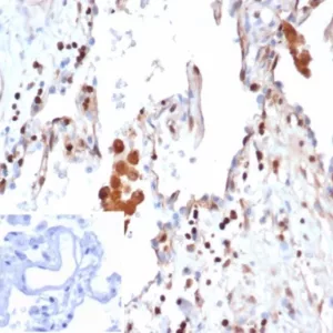 Formalin-fixed, paraffin-embedded human lung adenocarcinoma stained with S100A4 Mouse Monoclonal Antibody (S100A4/6995). Inset: PBS instead of primary antibody; secondary only negative control.