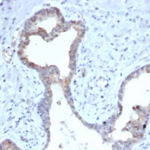 Formalin-fixed, paraffin-embedded human prostate stained with S100A5 Mouse Monoclonal Antibody (S100A5/7475).