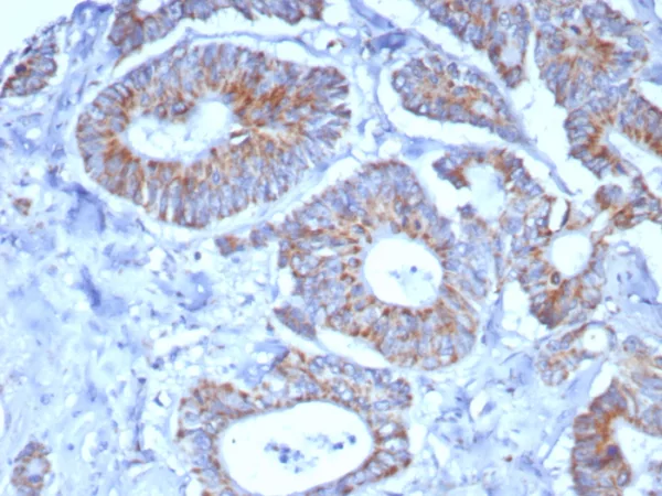 Formalin-fixed, paraffin-embedded human colon carcinoma stained with SDHA Mouse Monoclonal Antibody (SDHA/7491). HIER: Tris/EDTA, pH9.0, 45min. 2°C: HRP-polymer, 30min. DAB, 5min.