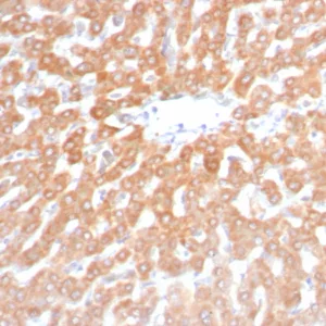 Formalin-fixed, paraffin-embedded human hepatocellular carcinoma stained with SDHB Recombinant Mouse Monoclonal Antibody (rSDHB/6948). HIER: Tris/EDTA, pH9.0, 45min. 2°C: HRP-polymer, 30min. DAB, 5min.