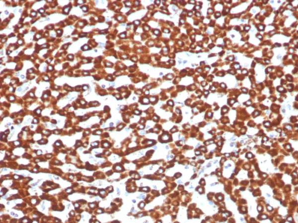 Formalin-fixed, paraffin-embedded human hepatocellular carcinoma stained with SDHB Recombinant Rabbit Monoclonal Antibody (SDHB/8974R). HIER: Tris/EDTA, pH9.0, 45min. 2°C: HRP-polymer, 30min. DAB, 5min.