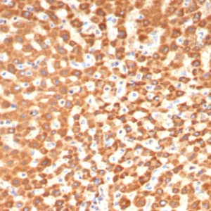 Formalin-fixed, paraffin-embedded human hepatocellular carcinoma stained with  SHBG Mouse Monoclonal Antibody (SHBG/8175). HIER: Tris/EDTA, pH9.0, 45min. 2°C: HRP-polymer, 30min. DAB, 5min.