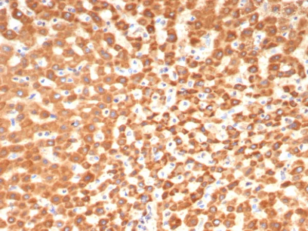 Formalin-fixed, paraffin-embedded human hepatocellular carcinoma stained with  SHBG Mouse Monoclonal Antibody (SHBG/8175). HIER: Tris/EDTA, pH9.0, 45min. 2°C: HRP-polymer, 30min. DAB, 5min.