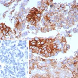 Formalin-fixed, paraffin-embedded human ovarian carcinoma stained with GLUT-1 Mouse Monoclonal Antibody (GLUT1/7308). Inset: PBS instead of primary antibody; secondary only negative control.