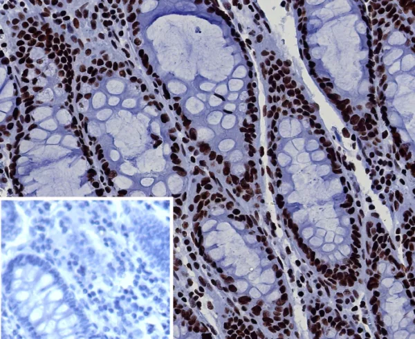 Formalin-fixed, paraffin-embedded human colon stained with BRG1 / Recombinant Rabbit Monoclonal Antibody (BRG1/7633R). Inset: PBS instead of primary antibody; secondary only negative control.