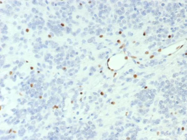 Formalin-fixed, paraffin-embedded human ovarian small cell carcinoma stained with BRG1 Recombinant Rabbit Monoclonal Antibody (BRG1/7633R). HIER: Tris/EDTA, pH9.0, 45min. 2: HRP-polymer, 30min. DAB, 5min.