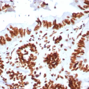 Formalin-fixed, paraffin-embedded human colon stained with BRG1 / Recombinant Rabbit Monoclonal Antibody (BRG1/8805R). HIER: Tris/EDTA, pH9.0, 45min. 2°C: HRP-polymer, 30min. DAB, 5min.