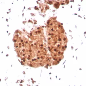 Formalin-fixed, paraffin-embedded human sarcoma stained with INI-1 Recombinant Rabbit Monoclonal Antibody (SMARCB1/8851R) HIER: Tris/EDTA, pH9.0, 45min. 2°C: HRP-polymer, 30min. DAB, 5min.