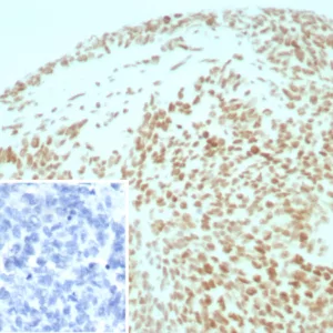 Formalin-fixed, paraffin-embedded human ovarian cancer stained with INI-1 Recombinant Rabbit Monoclonal Antibody (INI1/8935R) Inset: PBS instead of primary antibody; secondary only negative control.