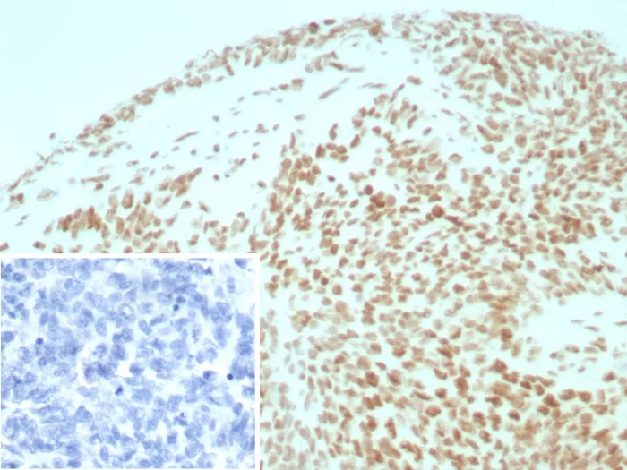 Formalin-fixed, paraffin-embedded human ovarian cancer stained with INI-1 Recombinant Rabbit Monoclonal Antibody (INI1/8935R) Inset: PBS instead of primary antibody; secondary only negative control. Recombinant Integrase interactor 1 (INI-1) / SNF5 / SMARCB1 Antibody