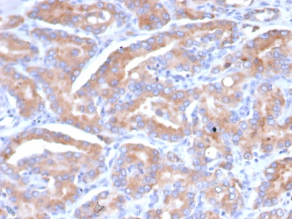 Formalin-fixed, paraffin-embedded human prostate stained with SI-CLP / CHID1 Mouse Monoclonal Antibody (CHID1/6368) HIER: Tris/EDTA, pH9.0, 45min. 2°C: HRP-polymer, 30min. DAB, 5min.