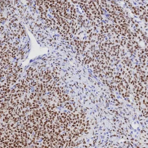 FFPE human ovarian adult granulosa cell tumor stained with FOXL2 Recombinant Rabbit Monoclonal Antibody (FOXL2/7989R). HIER: Tris/EDTA, pH9.0, 45min. 2: HRP-polymer, 30min. DAB, 5min.