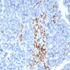 Formalin-fixed, paraffin-embedded human ovarian carcinoma stained with FOXL2 Recombinant Rabbit Monoclonal Antibody (FOXL2/8362R). Inset: PBS instead of primary antibody; secondary only negative control.