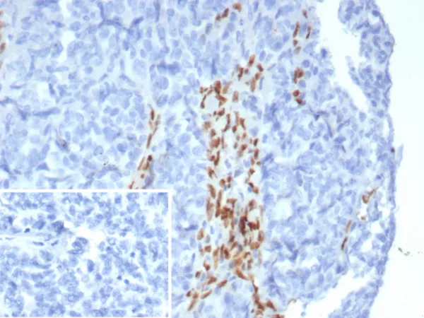 Formalin-fixed, paraffin-embedded human ovarian carcinoma stained with FOXL2 Recombinant Rabbit Monoclonal Antibody (FOXL2/8362R). Inset: PBS instead of primary antibody; secondary only negative control.