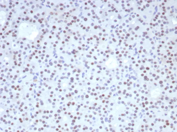 Formalin-fixed, paraffin-embedded human parathyroid stained with FOXL2 Recombinant Rabbit Monoclonal Antibody (FOXL2/8362R). HIER: Tris/EDTA, pH9.0, 45min. 2: HRP-polymer, 30min. DAB, 5min.