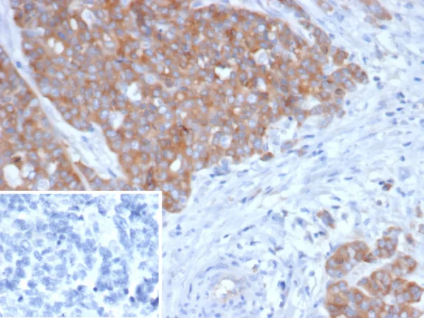 Formalin-fixed, paraffin-embedded human ovarian cancer stained with BRAF Mouse Monoclonal Antibody (BRAF/1626). Inset: PBS instead of primary antibody; secondary only negative control.