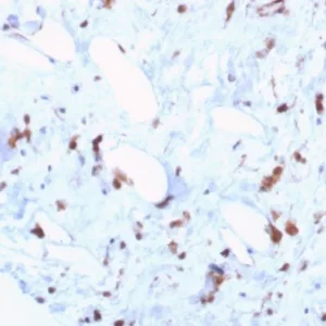 Formalin-fixed, paraffin-embedded human liposarcoma stained with STAT6 Recombinant Rabbit Monoclonal Antibody (STAT6/7774R). HIER: Tris/EDTA, pH9.0, 45min. 2°C: HRP-polymer, 30min. DAB, 5min.