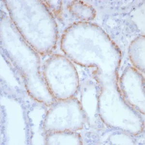 Formalin-fixed, paraffin-embedded human renal cell carcinoma stained with CD147 Mouse Monoclonal Antibody (BSG/7953) at 2ug/ml. HIER: Tris/EDTA, pH9.0, 45min. 2°C: HRP-polymer, 30min. DAB, 5min.