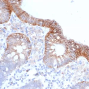 Formalin-fixed, paraffin-embedded human colon carcinoma stained with CD147 Mouse Monoclonal Antibody (BSG/3395) at 2ug/ml. HIER: Tris/EDTA, pH9.0, 45min. 2°C: HRP-polymer, 30min. DAB, 5min.