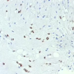 Formalin-fixed, paraffin-embedded human chordoma stained with TBXT Recombinant Rabbit Monoclonal Antibody (TBXT/7711R). HIER: Tris/EDTA, pH9.0, 45min. 2°C: HRP-polymer, 30min. DAB, 5min.