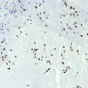 Formalin-fixed, paraffin-embedded human chordoma stained with TBXT Recombinant Rabbit Monoclonal Antibody (TBXT/7853R). HIER: Tris/EDTA, pH9.0, 45min. 2°C: HRP-polymer, 30min. DAB, 5min.