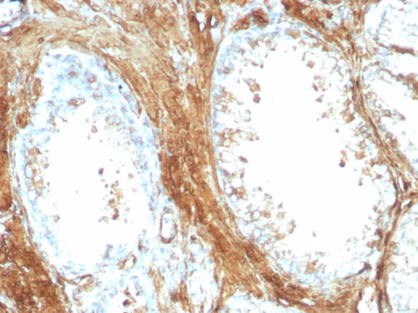 Formalin-fixed, paraffin-embedded human prostate carcinoma stained with Transgelin Recombinant Mouse Monoclonal Antibody (rTAGLN/8975). HIER: Tris/EDTA, pH9.0, 45min. 2°C: HRP-polymer, 30min. DAB, 5min.