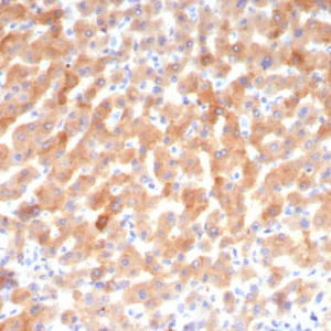 Formalin-fixed, paraffin-embedded human hepatocellular carcinoma stained with Transferrin Mouse Monoclonal Antibody (TF/4794). HIER: Tris/EDTA, pH9.0, 45min. 2: HRP-polymer, 30min. DAB, 5min.