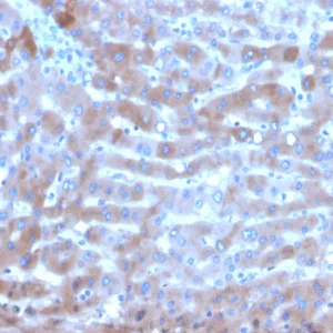 Formalin-fixed, paraffin-embedded human hepatocellular carcinoma stained with Transferrin Mouse Monoclonal Antibody (TF/4795). HIER: Tris/EDTA, pH9.0, 45min. 2°C: HRP-polymer, 30min. DAB, 5min.