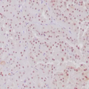 IHC analysis of formalin-fixed, paraffin-embedded human MiT translocation RCC. Nuclear staining using TFE3/6849R at 2ug/ml. HIER: Tris/EDTA, pH9.0, 45min. 2°: HRP-polymer, 30min. DAB, 5min.