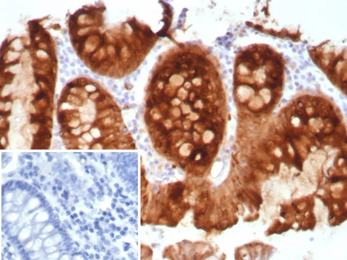 Formalin-fixed, paraffin-embedded human colon stained with Transferrin Recombinant Rabbit Monoclonal Antibody (TFF1/8817R). Inset: PBS instead of primary antibody; secondary only negative control. Recombinant pS2 / pNR-2 / TFF1 (Estrogen-Regulated Protein) Antibody
