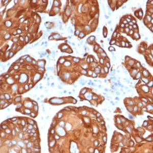 Formalin-fixed, paraffin-embedded human esophageal cancer stained with TIMP1 Mouse Monoclonal Antibody (TIMP1/4358). HIER: Tris/EDTA, pH9.0, 45min. 2°C: HRP-polymer, 30min. DAB, 5min.
