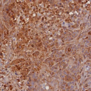 Formalin-fixed, paraffin-embedded human bladder carcinoma stained with TIMP2 Rabbit Recombinant Monoclonal Antibody (TIMP2/8193R). HIER: Tris/EDTA, pH9.0, 45min. 2: HRP-polymer, 30min. DAB, 5min.