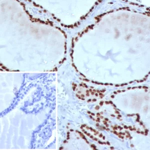 Formalin-fixed, paraffin-embedded human lung adenocarcinoma stained with TTF-1 Mouse Monoclonal Antibody (TTF1/8427). Inset: PBS instead of primary antibody; secondary only negative control.