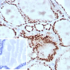 Formalin-fixed, paraffin-embedded human lung adenocarcinoma stained with TTF-1 Mouse Monoclonal Antibody (TTF1/8430). Inset: PBS instead of primary antibody; secondary only negative control.