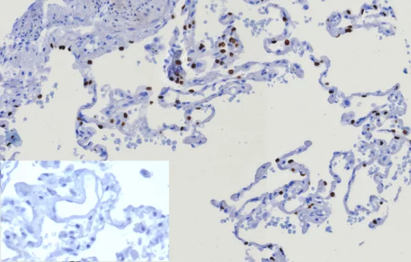 Formalin-fixed, paraffin-embedded human lung stained with TTF-1 Recombinant Rabbit Monoclonal Antibody (TTF1/8123R). Inset: PBS instead of primary antibody; secondary only negative control.
