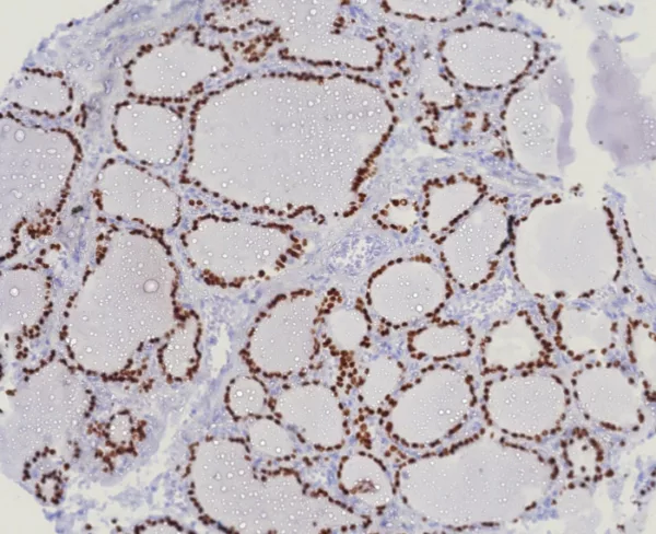 Formalin-fixed, paraffin-embedded human lung adenocarcinoma stained with TTF-1 Recombinant Rabbit Monoclonal Antibody (TTF1/8123R). HIER: Tris/EDTA, pH9.0, 45min. 2°C: HRP-polymer, 30min. DAB, 5min.