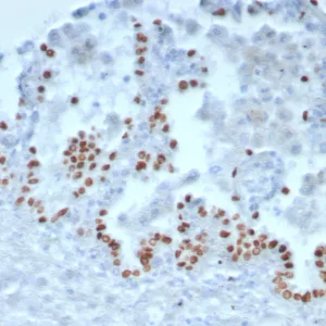 Formalin-fixed, paraffin-embedded human lung stained with TTF-1 Recombinant Rabbit Monoclonal Antibody (TTF1/8143R). HIER: Tris/EDTA, pH9.0, 45min. 2°C: HRP-polymer, 30min. DAB, 5min.