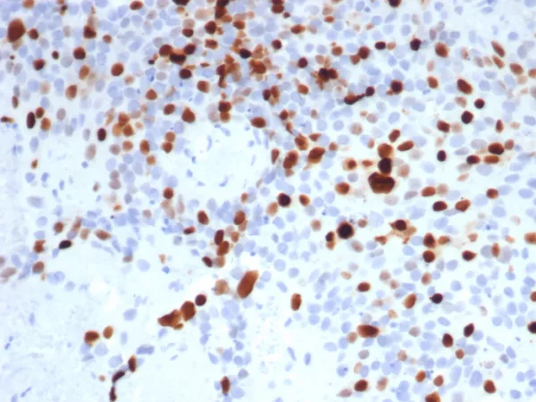 Formalin-fixed, paraffin-embedded human bladder cancer stained with Topo IIa Recombinant Rabbit Monoclonal Antibody (TOP2A/8103R). HIER: Tris/EDTA, pH9.0, 45min. 2°C: HRP-polymer, 30min. DAB, 5min.