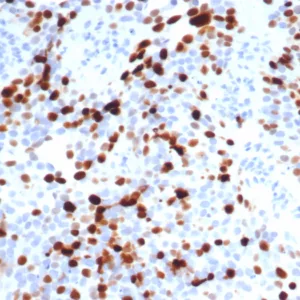 Formalin-fixed, paraffin-embedded human lymph node stained with Topo IIa Recombinant Rabbit Monoclonal Antibody (TOP2A/7148R). HIER: Tris/EDTA, pH9.0, 45min. 2°C: HRP-polymer, 30min. DAB, 5min.