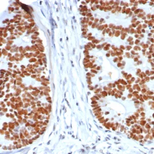 Formalin-fixed, paraffin-embedded human colon carcinoma stained with p53 Mouse Recombinant Monoclonal Antibody (rTP53/8063). HIER: Tris/EDTA, pH9.0, 45min. 2°C: HRP-polymer, 30min. DAB, 5min.