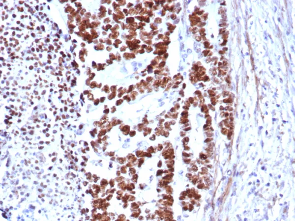 Formalin-fixed, paraffin-embedded human colon carcinoma stained with p53 Mouse Recombinant Monoclonal Antibody (rTP53/8579).