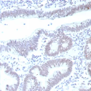 Formalin-fixed, paraffin-embedded human colon carcinoma stained with p53 Recombinant Mouse Monoclonal Antibody (rTP53/8993). HIER: Tris/EDTA, pH9.0, 45min. 2°C: HRP-polymer, 30min. DAB, 5min.